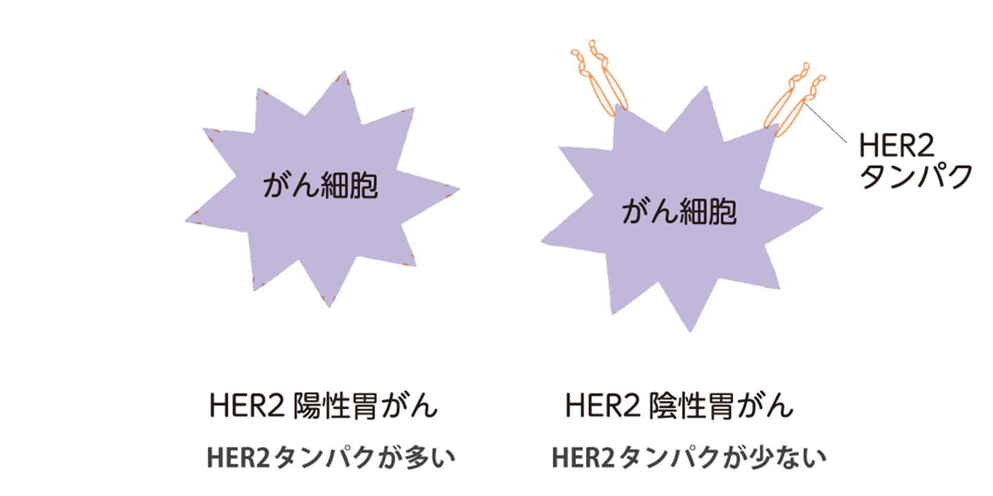 がん細胞の表面にあるHER2タンパクの量の違いを示した図。HER2陽性胃がんは多く、HER2低発現・超低発現胃がんはある程度／少しあり、HER2陰性胃がんはほぼまったくない。