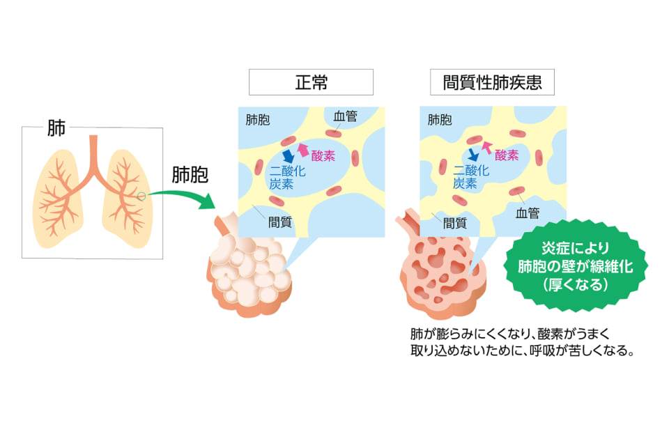 正常な肺胞と間質性肺疾患の肺胞を比較した図。炎症で肺胞の壁が線維化して厚くなり、酸素をうまく取り込めず呼吸が苦しくなることを示す。