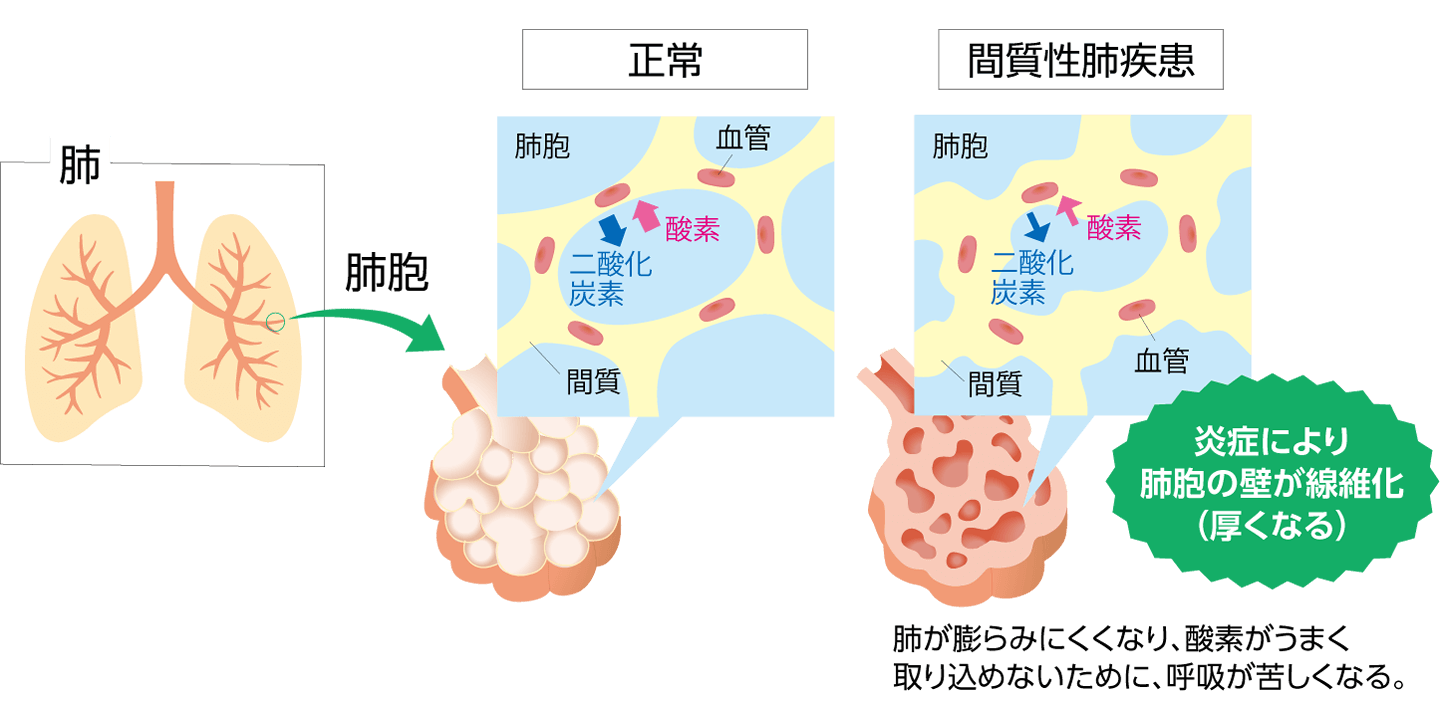 肺が正常な場合は十分に酸素を取り込めるが、「間質性肺疾患」は炎症により肺胞の壁が繊維化（厚くなる）し、肺が膨らみにくくなり、酸素がうまく取り込めないために、呼吸が苦しくなる。