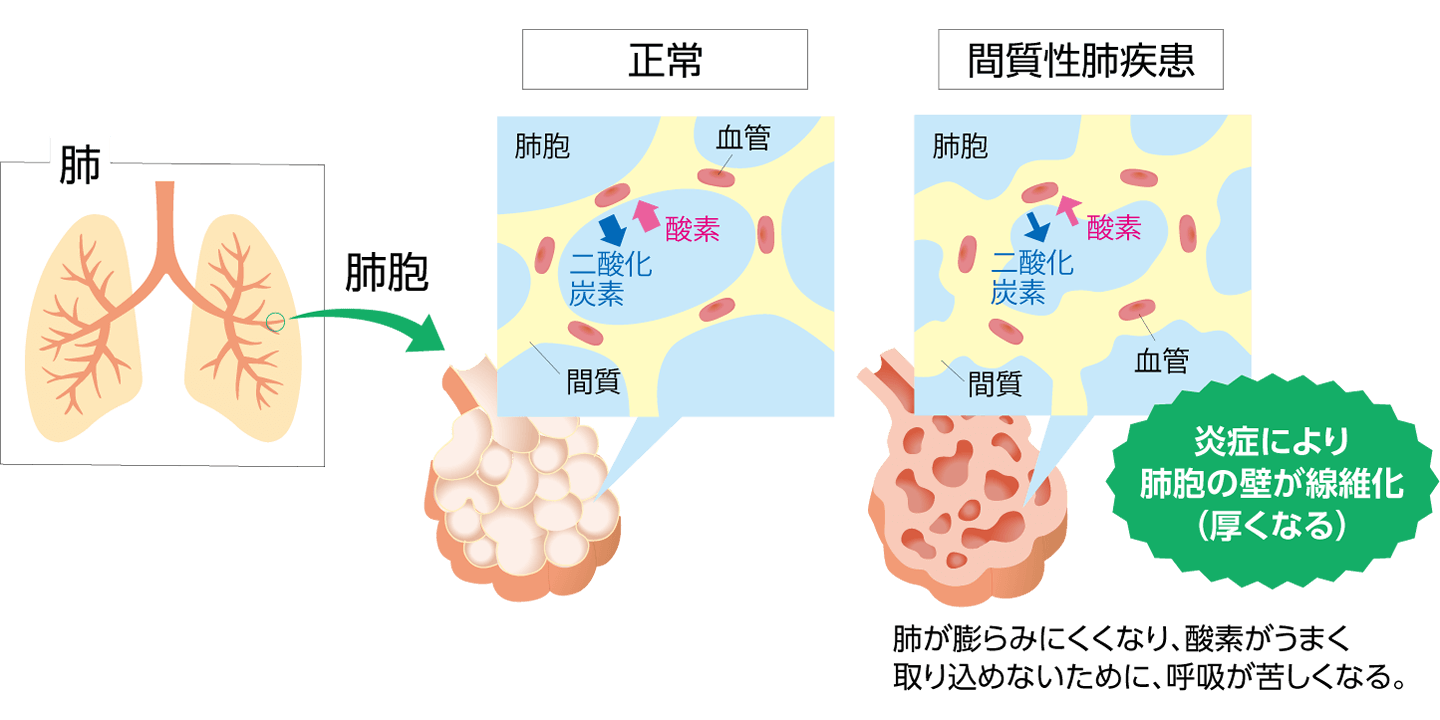 間質性肺疾患とは？