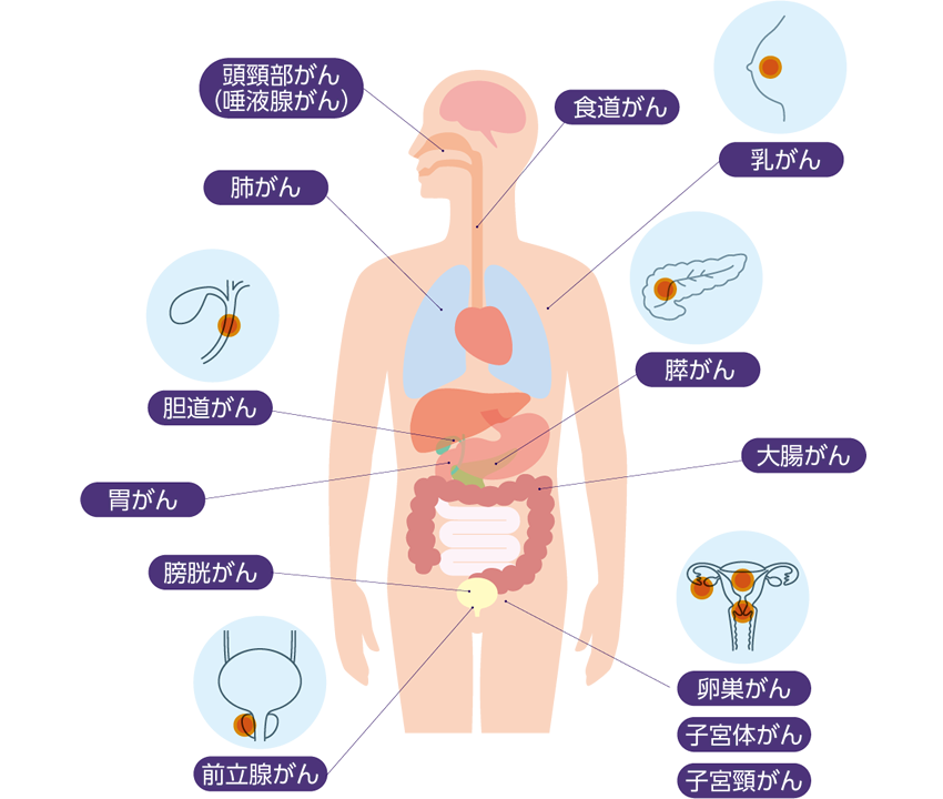 「頭頚部がん（唾駅腺がん）、食道がん、乳がん、肺がん、胆道がん、膵がん、胃がん、大腸がん、膀胱がん、前立腺がん、卵巣がん、子宮体がん、子宮頸がん」の位置を説明する人体イラスト